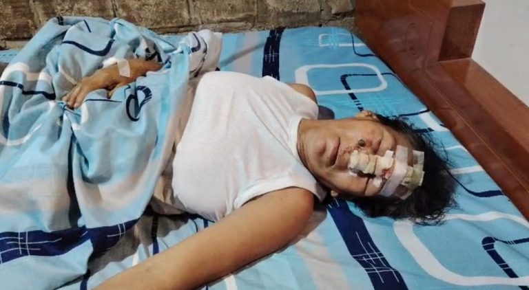 Mujer sufre grave caída desde escalera de cuatro metros y pide apoyo solidario