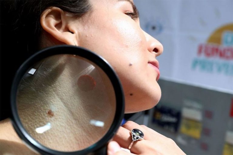 Iquitos se suma al Día del Lunar con campaña gratuita para prevenir el cáncer de piel
